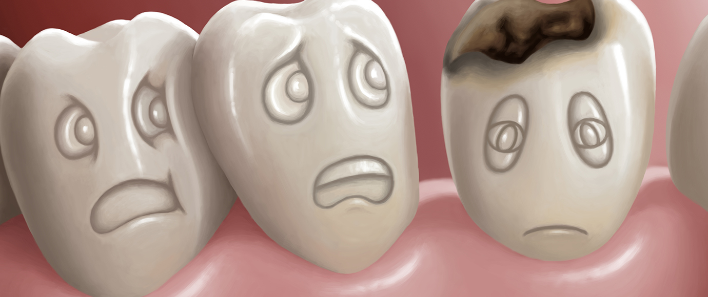 歯の痛みは虫歯が進行している証拠です