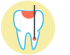 根管治療